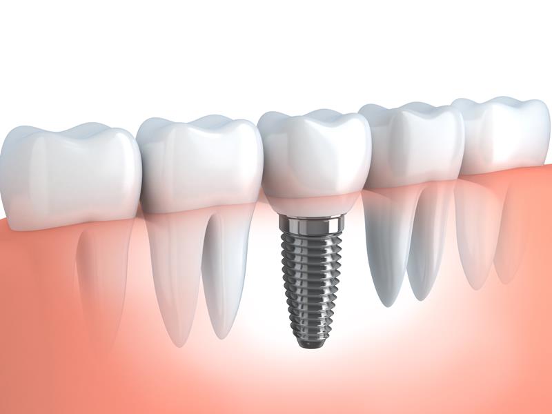 Dental Implants Chicopee, MA ,