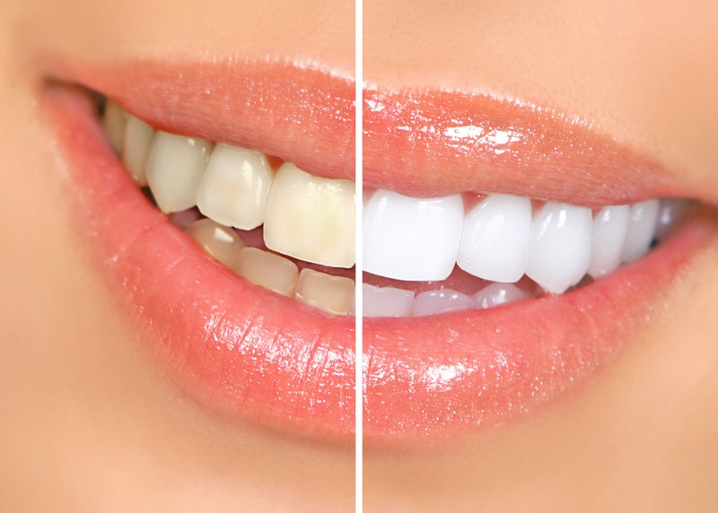 Teeth Whitening  Chicopee, MA ,